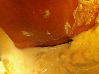 Casting Your Foot: Removing Your Foot