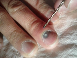 How To Drain Your Subungual Hematoma Blood Pocket Under Finger Nail With A Drill Bit 6 Steps With Pictures Instructables How To Drain Your Subungual Hematoma Blood Pocket Under Finger Nail With A Drill Bit 6 Steps With Pictures Instructables