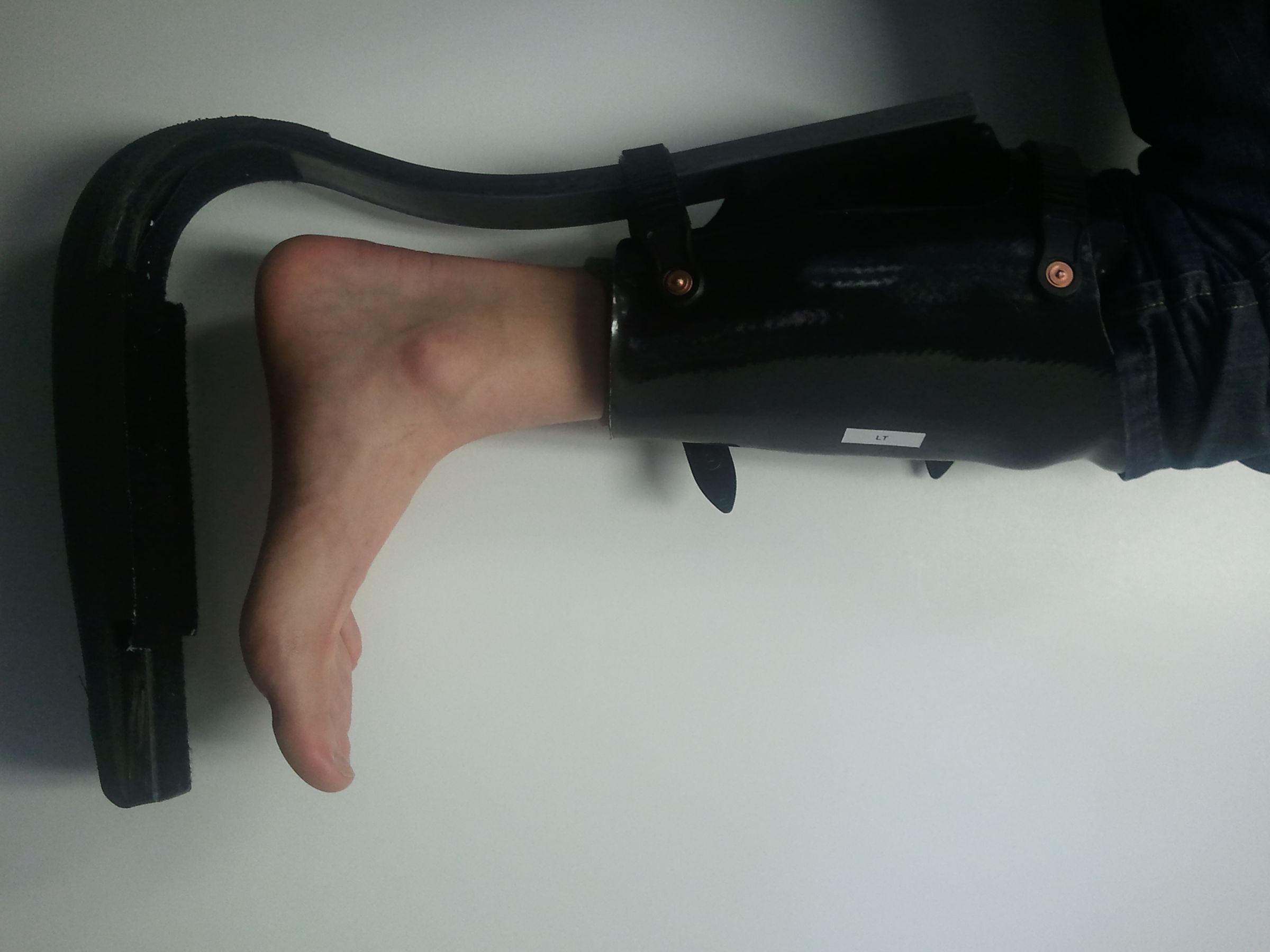 Improve the Toad AntiGravity Foot Brace ("TAG" Brace) 6 Steps