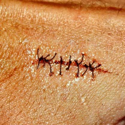 a very easy to do very convincing scar! DIY Project DIY Project Image