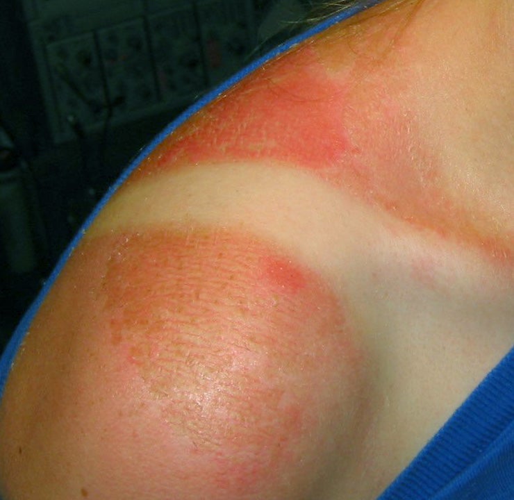 The Single Most Effective Way to Get Rid of a Sunburn : 3 Steps (with ...