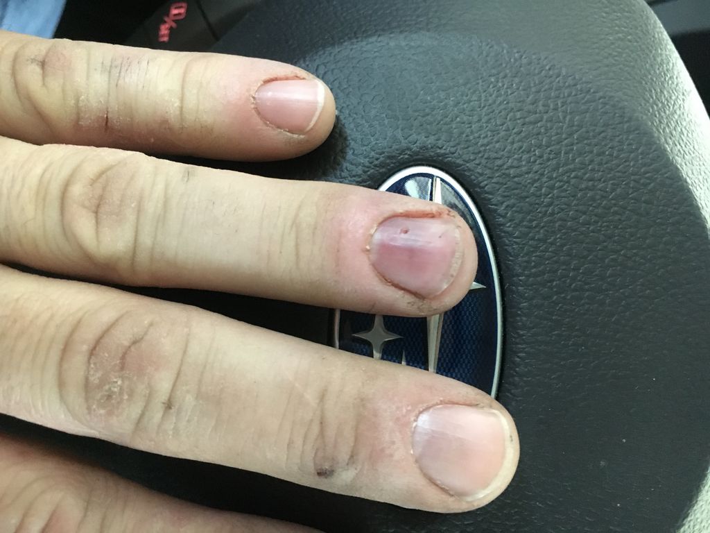 How to Drain Your Subungual Hematoma (blood Pocket Under Fingernail