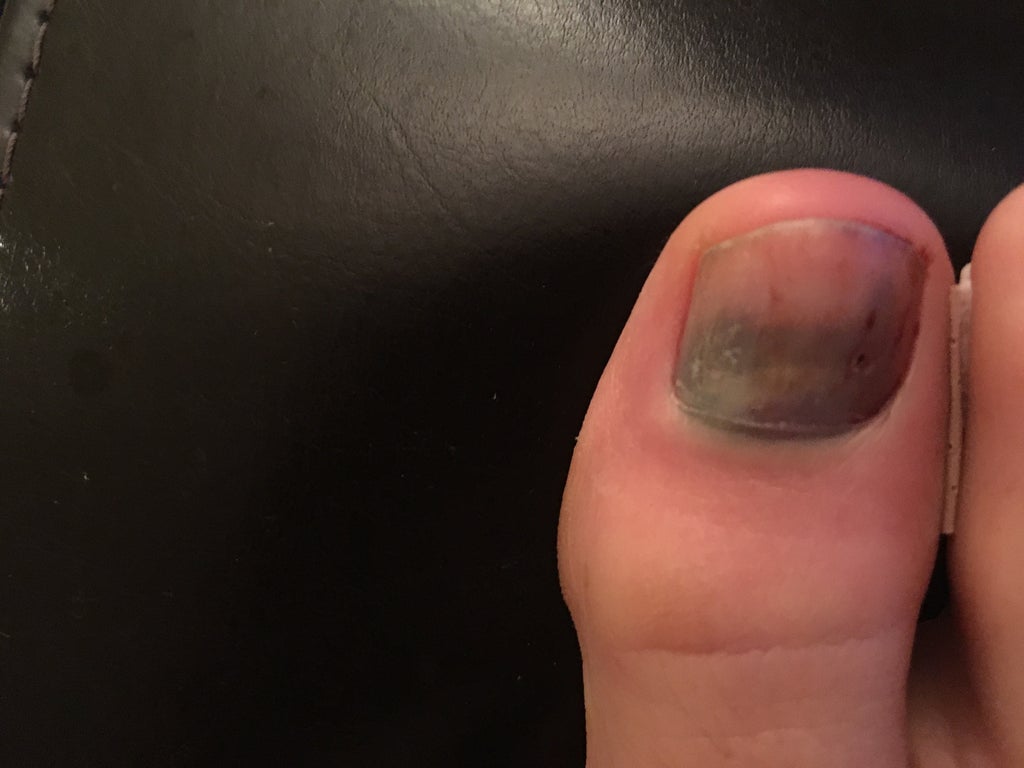 How To Drain Your Subungual Hematoma Blood Pocket Under Finger Nail With A Drill Bit 6 Steps With Pictures Instructables How To Drain Your Subungual Hematoma Blood Pocket Under Finger Nail With A Drill Bit 6 Steps With Pictures Instructables