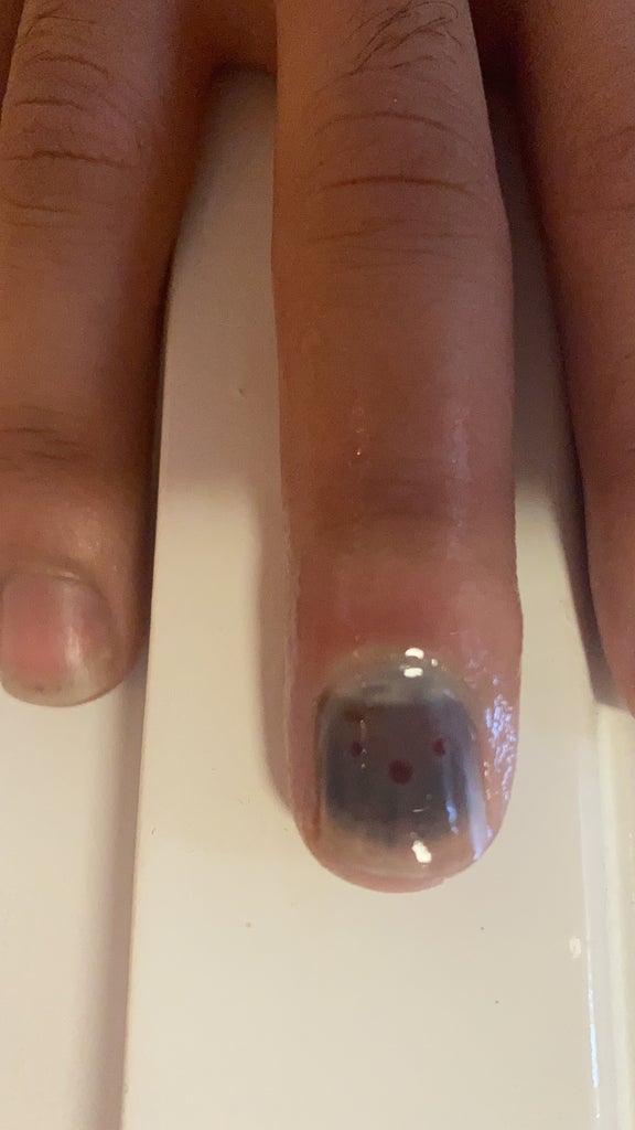 How To Drain Your Subungual Hematoma Blood Pocket Under Finger Nail With A Drill Bit 6 Steps With Pictures Instructables How To Drain Your Subungual Hematoma Blood Pocket Under Finger Nail With A Drill Bit 6 Steps With Pictures Instructables