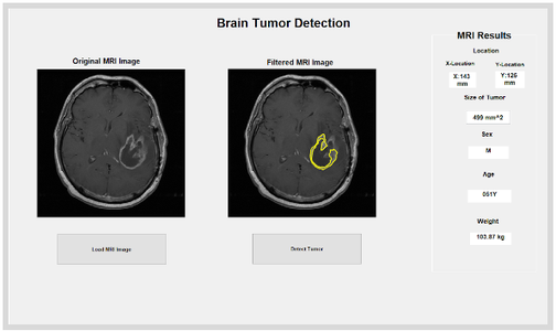 Brain Tumor MRI Detection Using Matlab : 6 Steps - Instructables