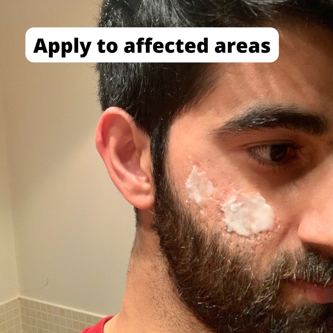 Home Remedies to Reduce Acne Redness Overnight 7 Steps Instructables